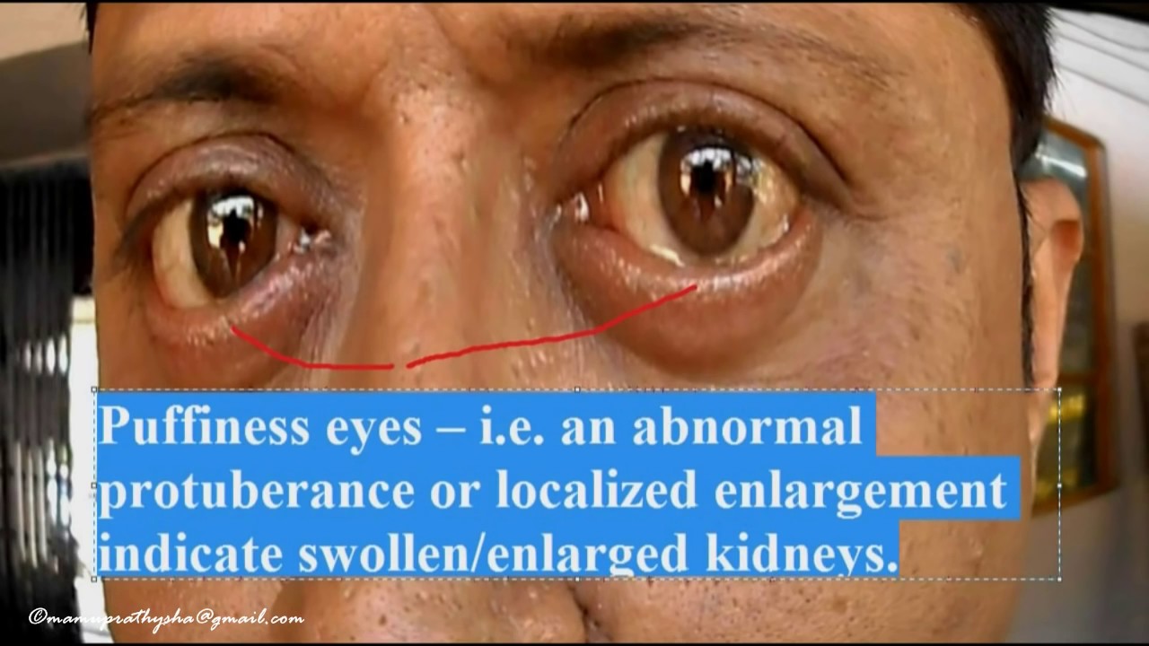 This type of eyes means swollen/enlarged kidneys - Your face shows how