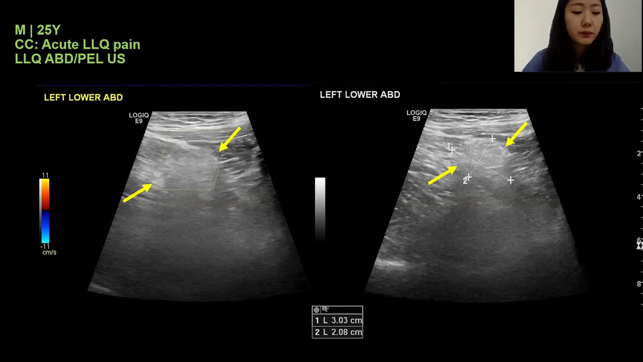Charlotte Yoon  Presents on Epiploic Appendigitis