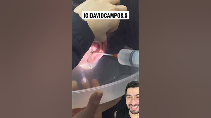 QUEDO SORDA PORQUE TENIA UN TAPÓN DE CERA EN SU OÍDO