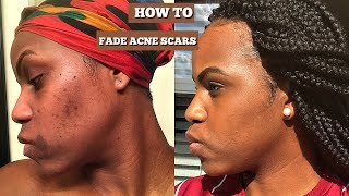 How to fade acne and scars | Hyperpigmentation ft. Ambi fade cream