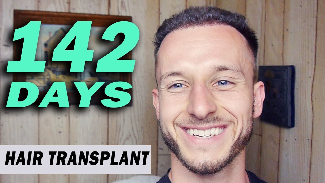 Fue Hair Transplant 142 Days (Post Op) Istanbul, Turkey Growth Stage