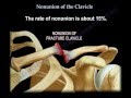 Nonunion Of The Clavicle - Everything You Need To Know - Dr. Nabil Ebraheim