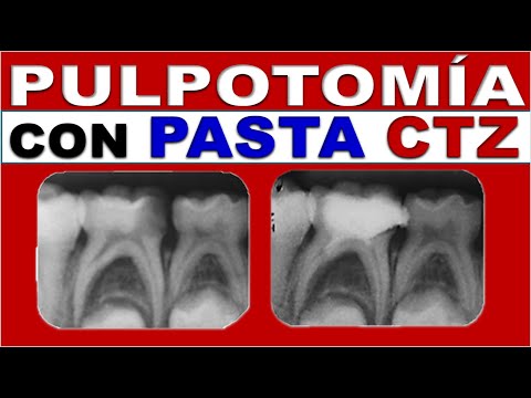 Vídeo: La pulpotomia i la pulpectomia és el mateix?