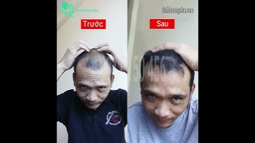 Làm Sao Kích Thích #TÓC Mọc Dài #NHANH - An toàn hiệu quả