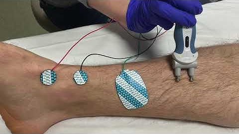 Saphenous Nerve Conduction Studies: Proximal and Distal techniques