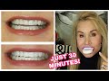 💝 How to Get Whiter Teeth Fast | See How I Got Blindingly White Teeth At Home | Super Cheap Too! 💝