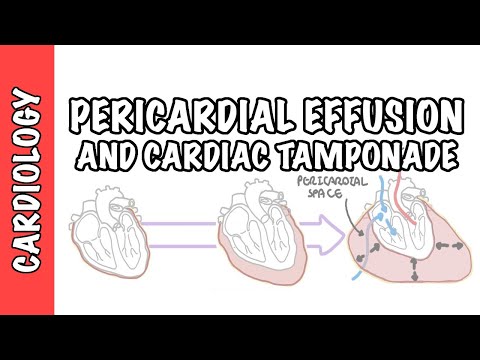 Video: Ar perikardo tamponada yra tokia pati kaip širdies tamponada?