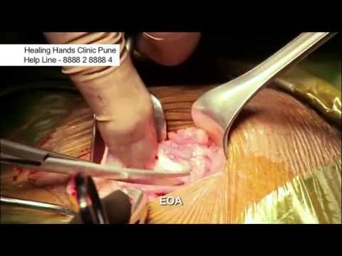 General Surgery Inguinal Hernia