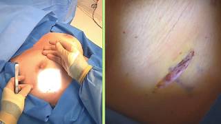 Breast Implant Exchange Michael J. Brown, Md Live Stream