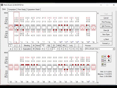 chart eaglesoft perio
