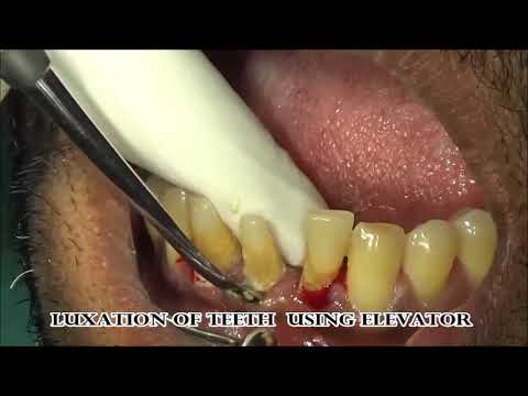 Video: 3 Ways to Extract Teeth