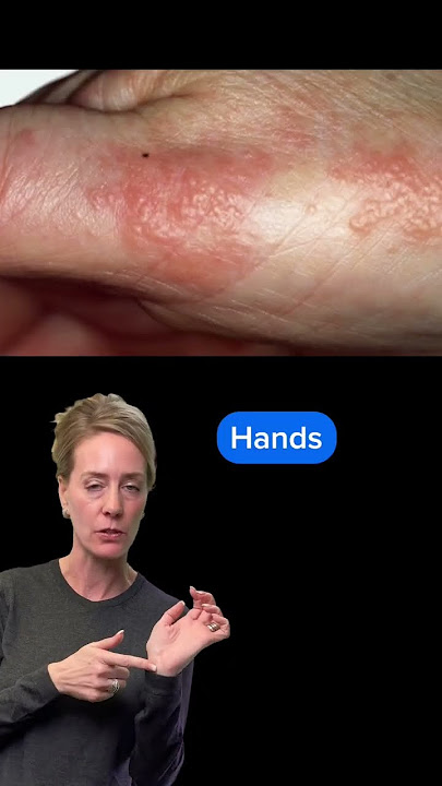 Download lagu #Eczema doesn’t look the same on everyone #atopicdermatitis #eczemaawareness