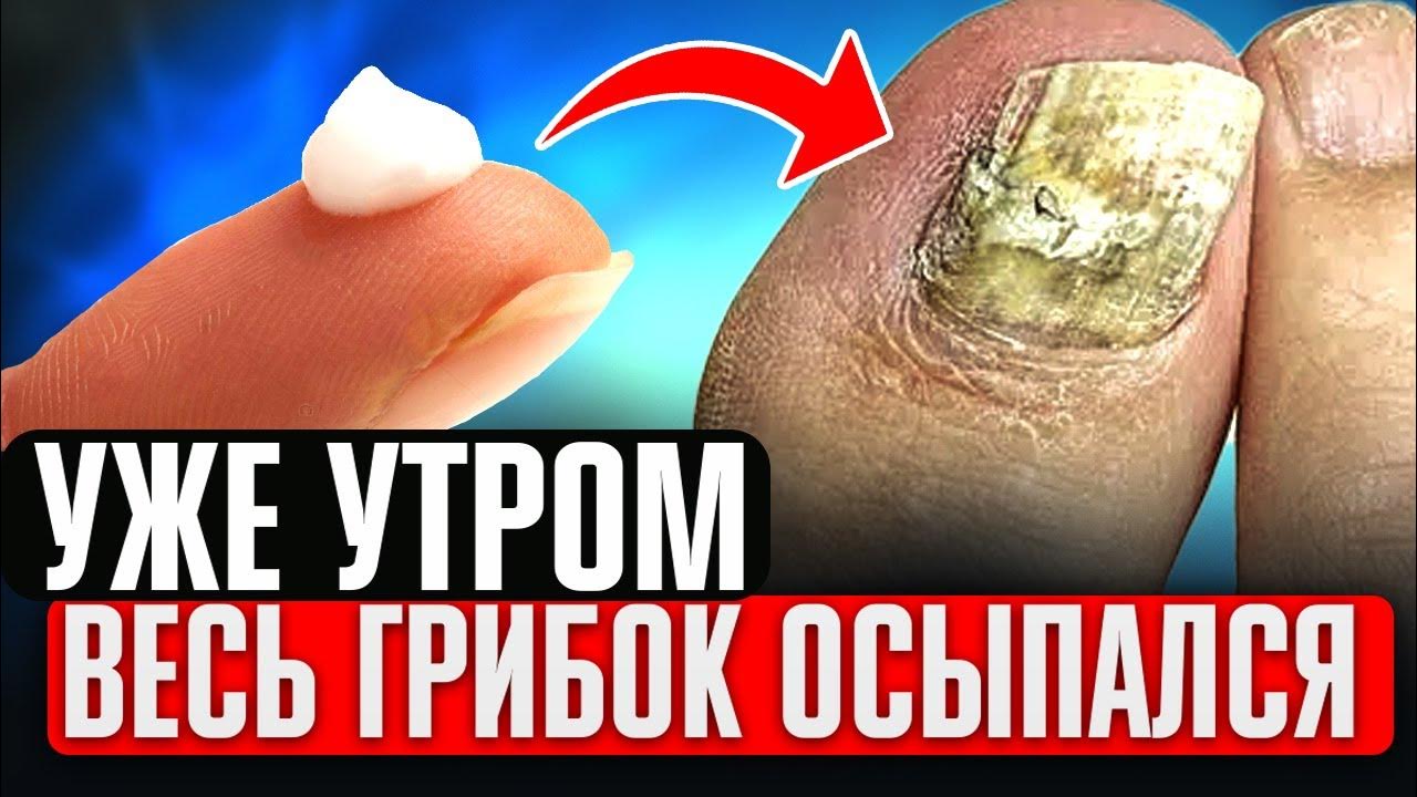 Даже за 4 мин. Грибок осыпается! Запомни 1 народный способ как ...
