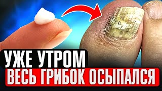 Даже за 4 мин. Грибок осыпается! Запомни 1 народный способ как избавиться от грибка ногтей (важно)