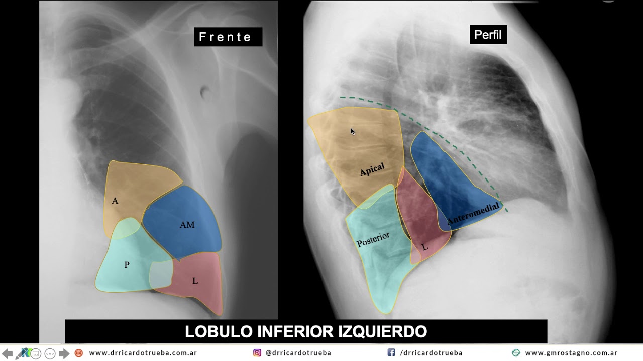 RADIOLOGIA NORMAL DEL TORAX EN 15 MINUTOS YouTube
