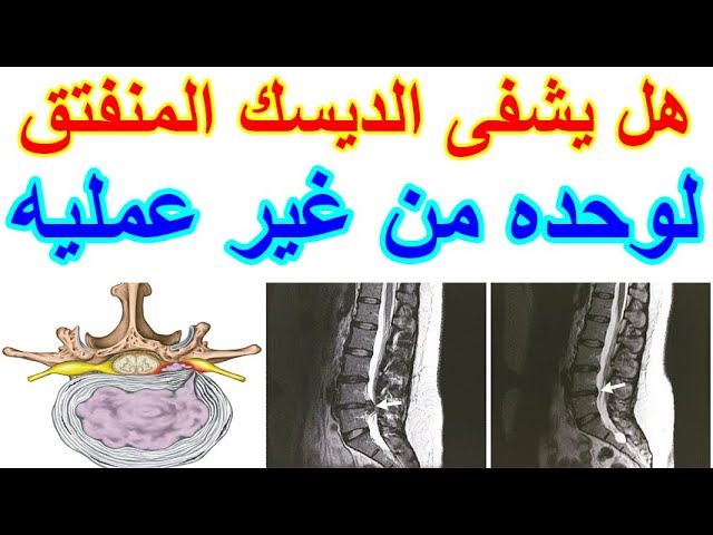 هل من الممكن ان يرجع الغضروف الى طبيعته؟