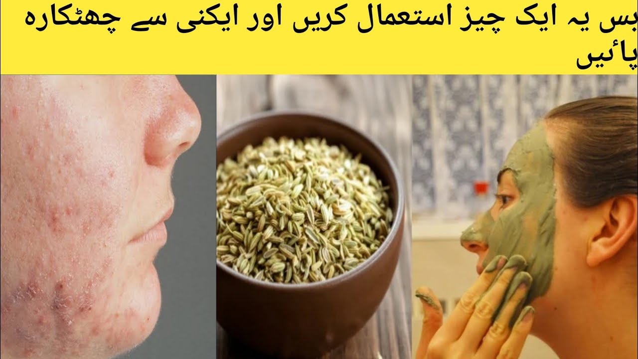 How to remove pimple overnight acne treatment home remedie - how to remove pimple over night, acne treatment, how to get rid of pimples,...