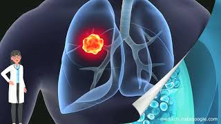 Arts Vertelt Over Longkanker En De Levensverwachting Die Eraan Verbonden Is