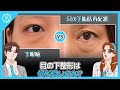 目の下脂肪再配置VS眼瞼下垂VSデュアル眼瞼下垂 似ていながらも違う部分を持つ手術の違いは何か？オブジェ整形外科整形の定石！ジャンウク院長のアドバイスポイント