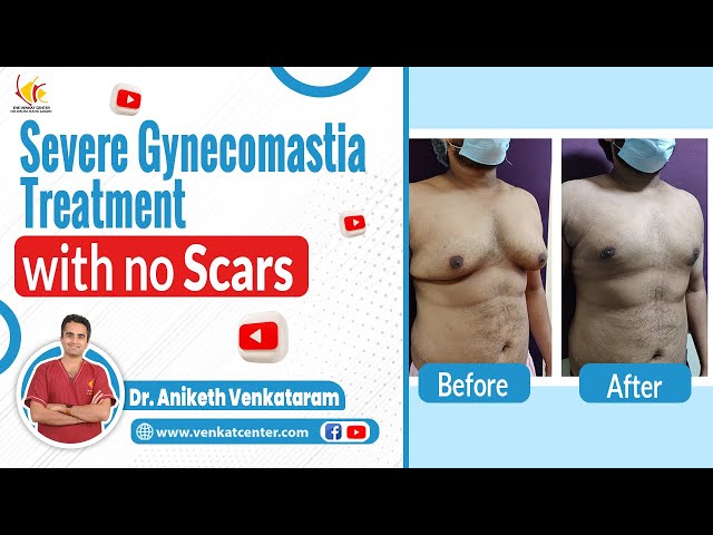 Severe Gynecomastia Surgery with Minimal Scars | Different Grades of Gynecomastia | Venkat Center