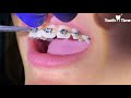 Brackets Repositioning - Braces Check up - Heat activated wire - Tooth Time New Braunfels-Seguin