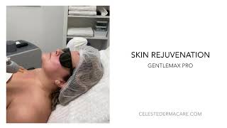 Neck Skin Rejuvenation By C Dermacare - Candela Gentlemax Pro
