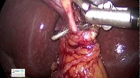 Laparoscopic Cholecystectomy -gallbladder removal by Max Hospital
