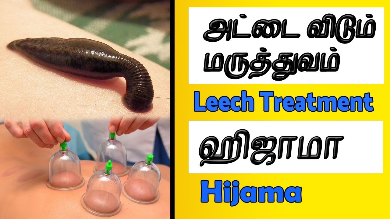 tamil bigg boss 3 leech and hijama treatment in tamil | அட்டை விடும் மருத்துவம் மற்றும் ஹிஜாமா மருத்துவத்தின் நன்மைகள்