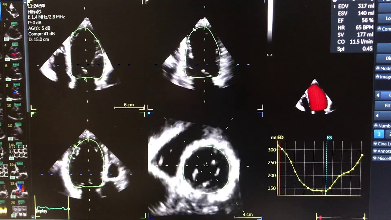Aortic Valve Prolapse YouTube