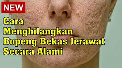 Cara Menghilangkan Bopeng Bekas Jerawat Secara Alami - Durasi: 6.02. Cara Menghilangkan Bopeng Bekas Jerawat Secara Alami - Durasi: 6.02.