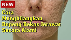 Cara Menghilangkan Bopeng Bekas Jerawat Secara Alami - Durasi: 6.02. 