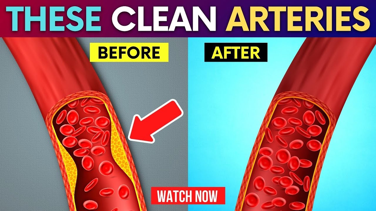 9 Simple Remedies to Clean Arteries and Control Lower Bad Cholesterol