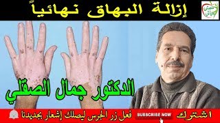 إزالة البهاق نهائياً مع الدكتور جمال الصقلي