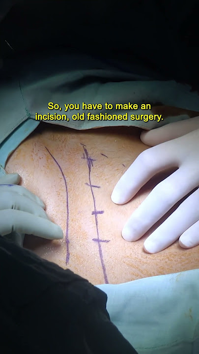 Open Cholecystectomy for Gallbladder Disease #jomi #surgicaleducation #learnwithjomi #surgery