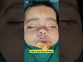 Cleft Lip &amp; Nose Repair Surgery | Best Results | Dr Parit Ladani