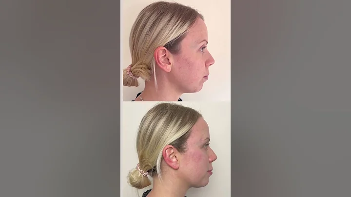 Dermal Fillers Treatment on Patient ft. Nicola | T...