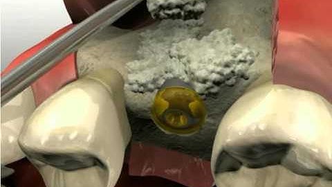 Implants   Allografting Exposed Threads