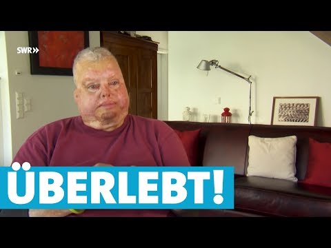 Bernhard überlebt Flugzeug-Explosion trotz schwerer Verbrennungen