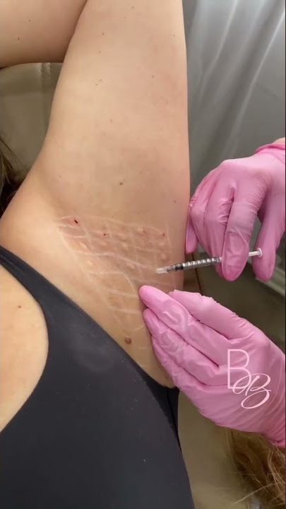 Worried about those sweaty underarms? 😥 Here's the ultimate botox hack! 💦