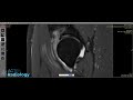 Hip Case from Saturday Evening MSK Radiology LIVE - in 4K (21:9 ratio)