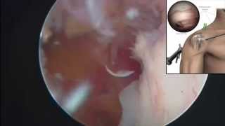 Arthroscopic HAGL repair