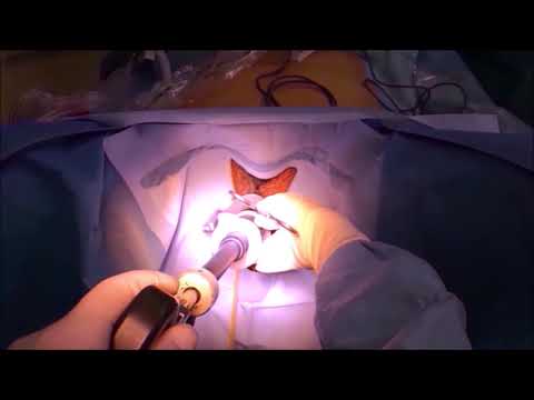 Laparoscopic sentinel lymph node mapping