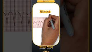 شرح (Ventricular Tachycardia) من حالات رسم القلب