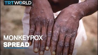 Rare monkeypox outbreak spreads to UK, Europe and US