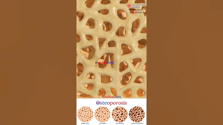Osteoporosis 🦴 Osteopenia - DayDayNews