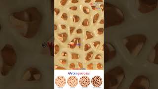 Osteoporosis 🦴 Osteopenia