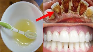 How To Whiten Teeth at Home in 5 Minutes - जादुई दांत सफेद करने का उपाय