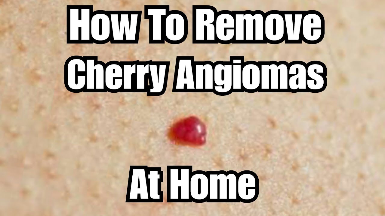 Diy Removing Cherry Angiomas At Home Youtube 