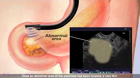 Endoscopic Ultrasound