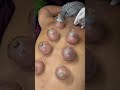 Hijama cupping #physiotherapy #hijamacupping